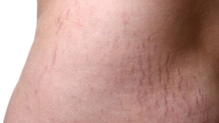 Sederet Cara Menghilangkan Stretch Mark Setelah melahirkan, bekas bisa tersamarkan!