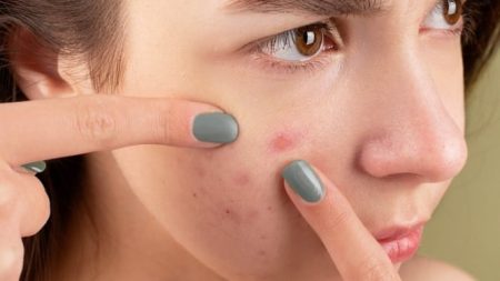 Tak Perlu Ke Dokter! Ini 5 Acne Spot Terbaik Yang Terbukti AMPUH Menggerkan Jerawat Dalam Waktu Singkat